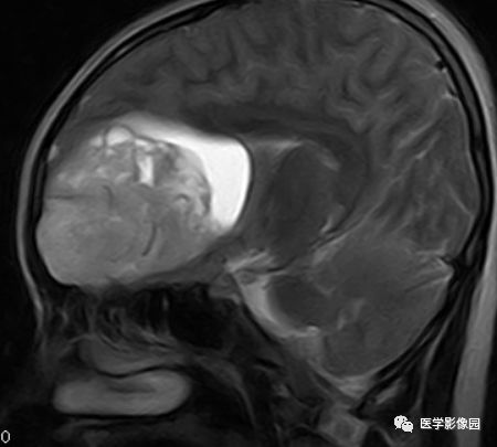 【病例】右额叶室管膜瘤1例MR影像表现 【病例】右额叶室管膜瘤1例MR影像表现