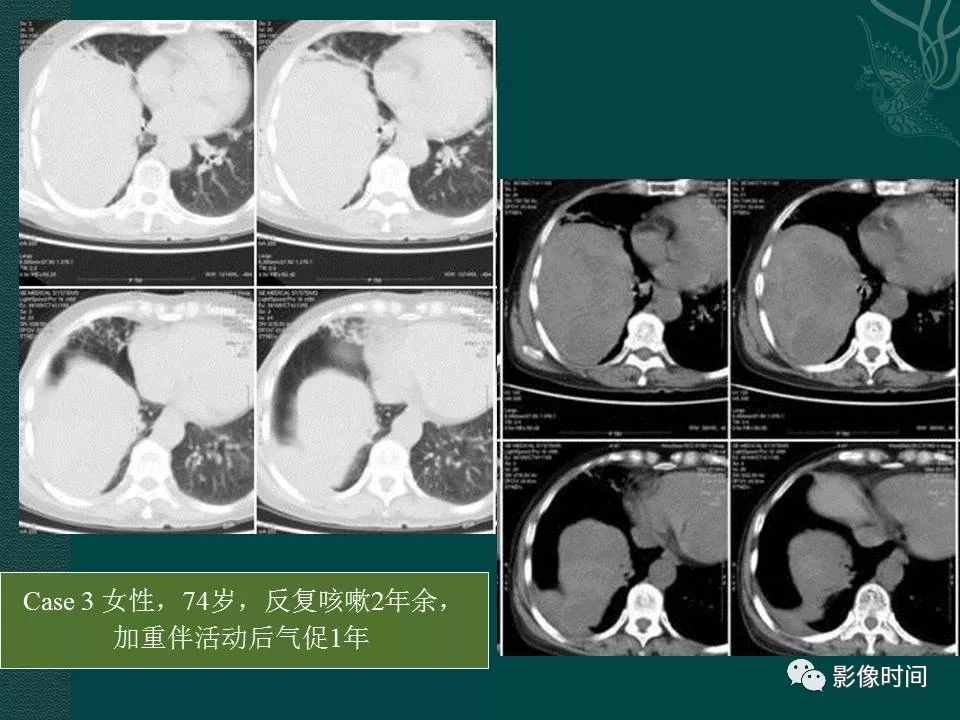 【PPT】胸膜孤立性纤维瘤的CT诊断与鉴别诊断