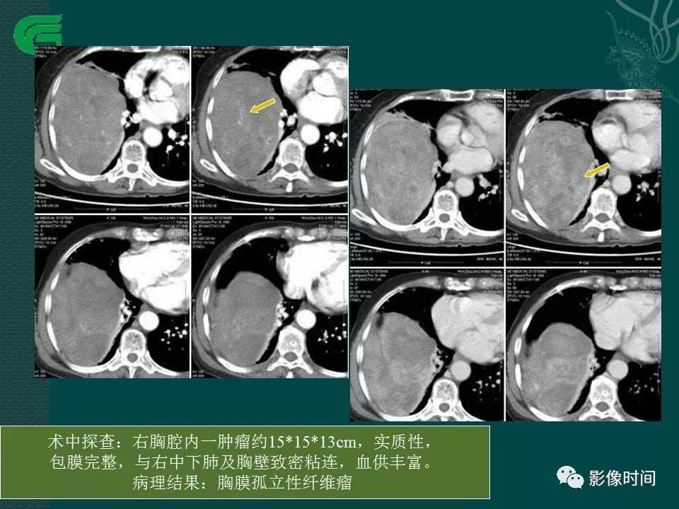 【PPT】胸膜孤立性纤维瘤的CT诊断与鉴别诊断