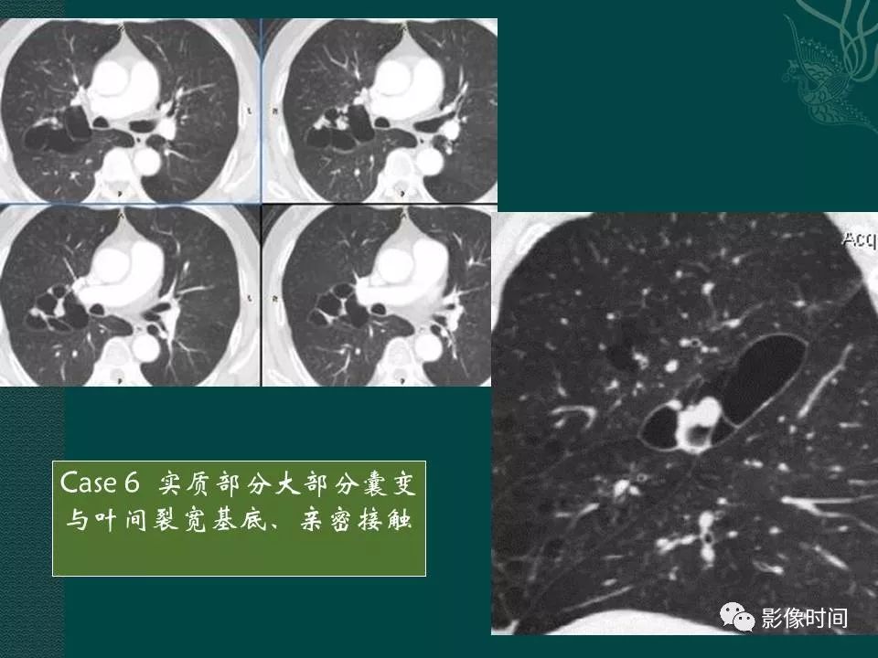 【PPT】胸膜孤立性纤维瘤的CT诊断与鉴别诊断