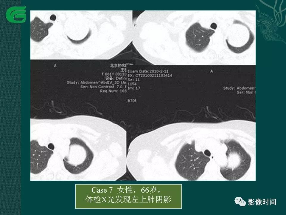 【PPT】胸膜孤立性纤维瘤的CT诊断与鉴别诊断