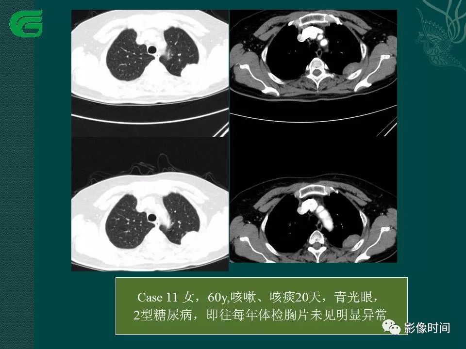 【PPT】胸膜孤立性纤维瘤的CT诊断与鉴别诊断