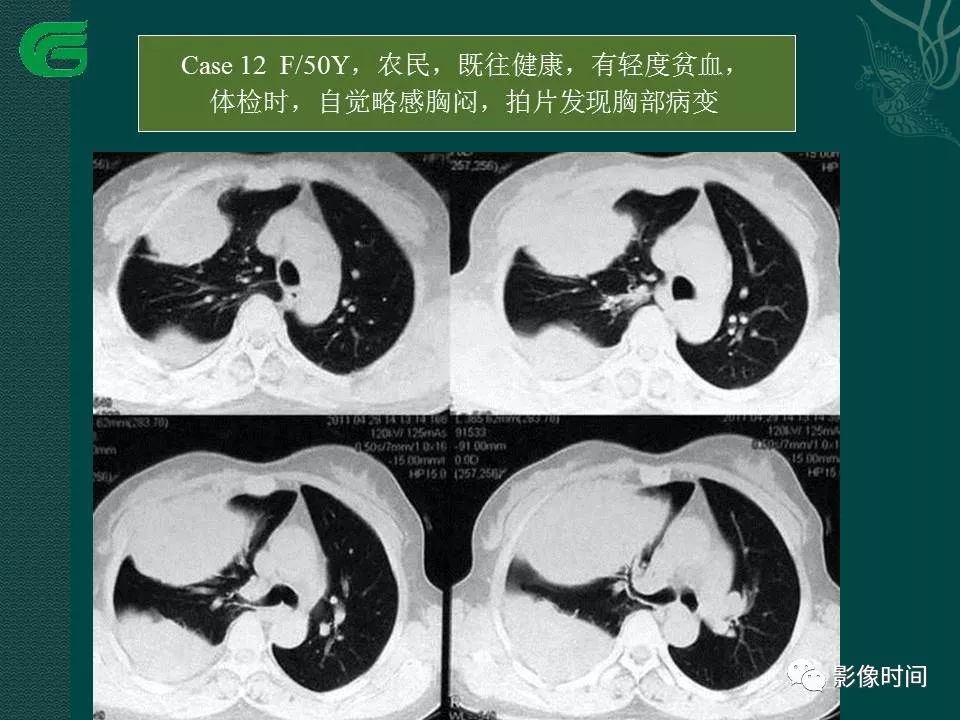【PPT】胸膜孤立性纤维瘤的CT诊断与鉴别诊断