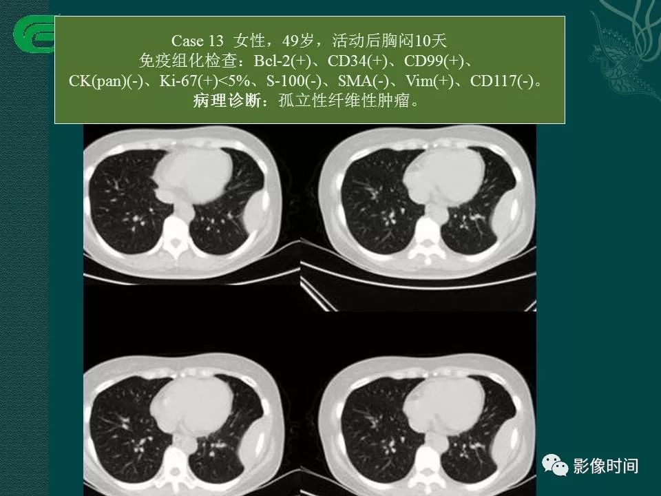 【PPT】胸膜孤立性纤维瘤的CT诊断与鉴别诊断