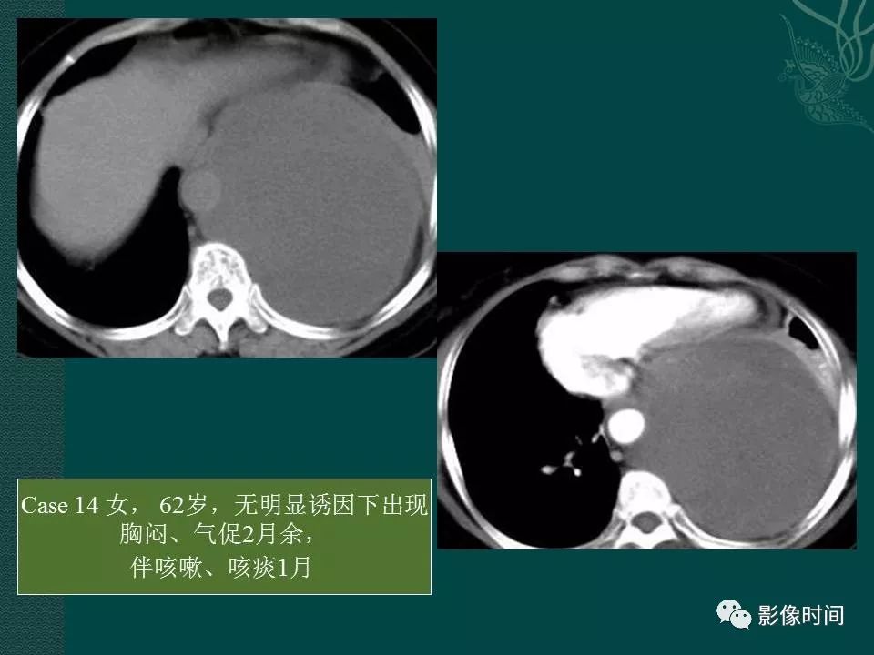 【PPT】胸膜孤立性纤维瘤的CT诊断与鉴别诊断