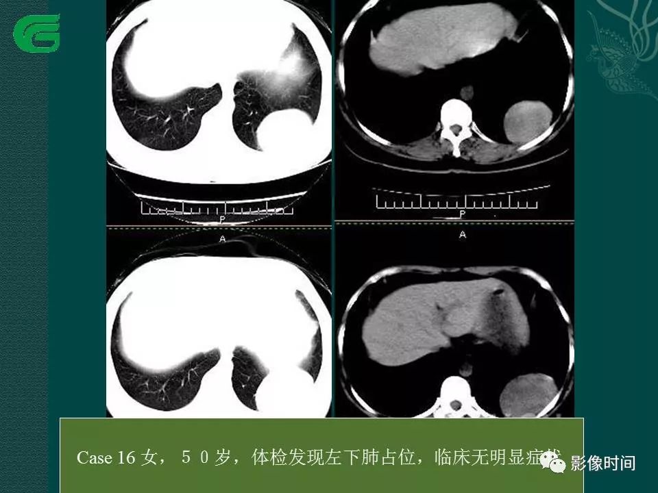 【PPT】胸膜孤立性纤维瘤的CT诊断与鉴别诊断