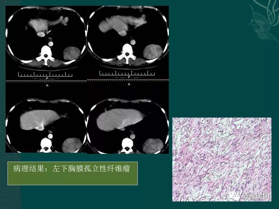 【PPT】胸膜孤立性纤维瘤的CT诊断与鉴别诊断