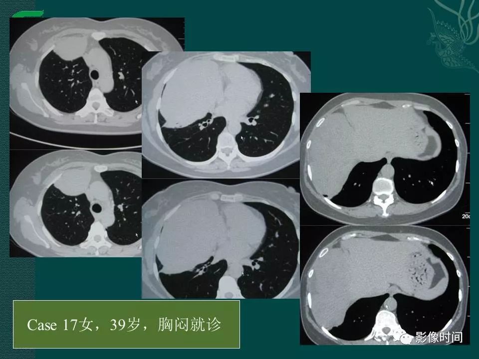 【PPT】胸膜孤立性纤维瘤的CT诊断与鉴别诊断