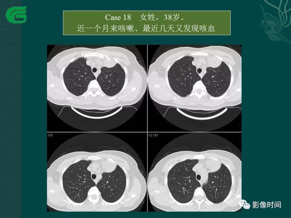 【PPT】胸膜孤立性纤维瘤的CT诊断与鉴别诊断