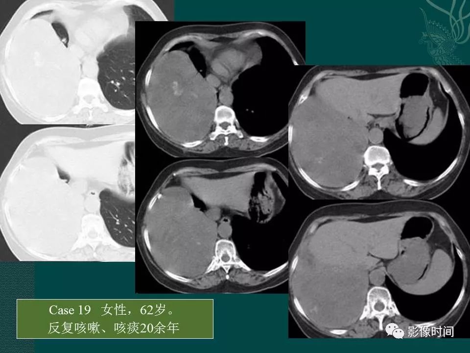 【PPT】胸膜孤立性纤维瘤的CT诊断与鉴别诊断