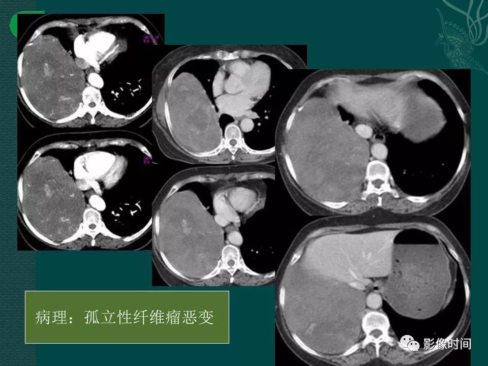 【PPT】胸膜孤立性纤维瘤的CT诊断与鉴别诊断