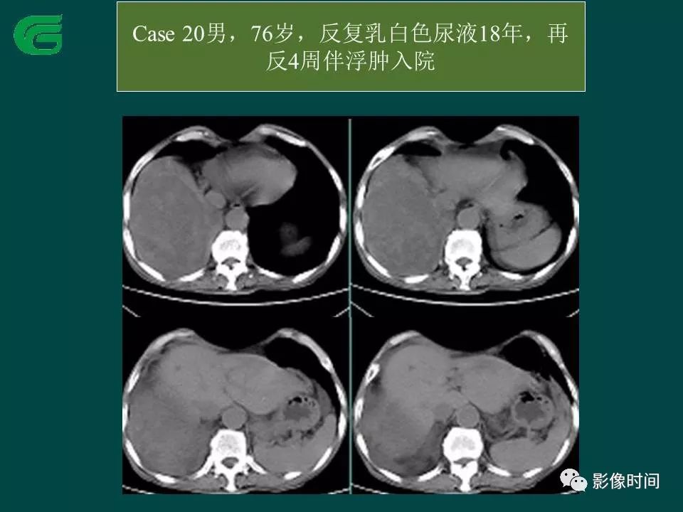 【PPT】胸膜孤立性纤维瘤的CT诊断与鉴别诊断