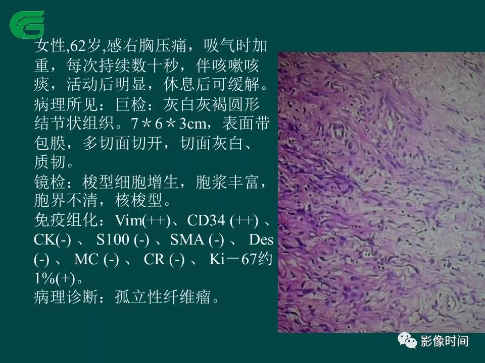 【PPT】胸膜孤立性纤维瘤的CT诊断与鉴别诊断