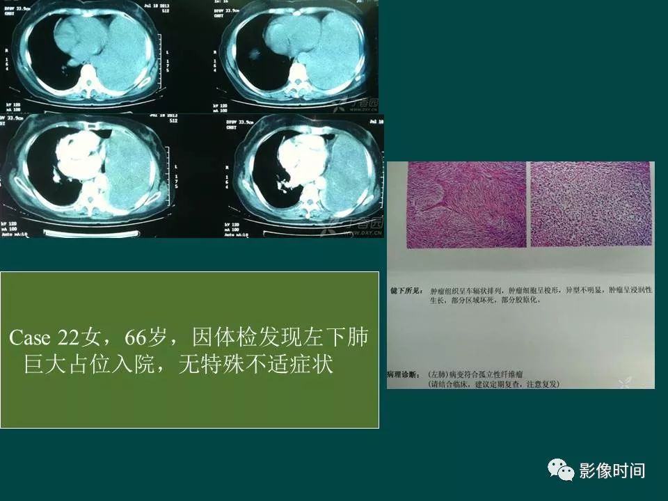 【PPT】胸膜孤立性纤维瘤的CT诊断与鉴别诊断