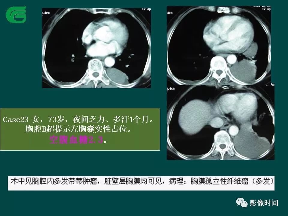 【PPT】胸膜孤立性纤维瘤的CT诊断与鉴别诊断