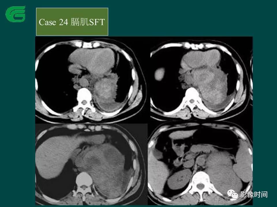 【PPT】胸膜孤立性纤维瘤的CT诊断与鉴别诊断