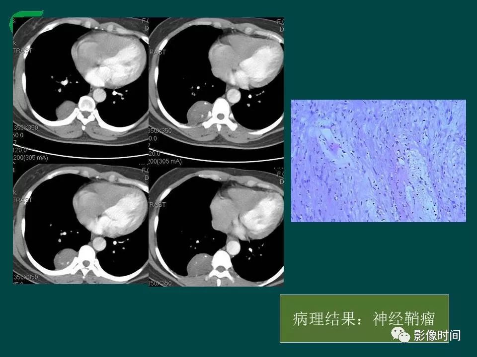 【PPT】胸膜孤立性纤维瘤的CT诊断与鉴别诊断