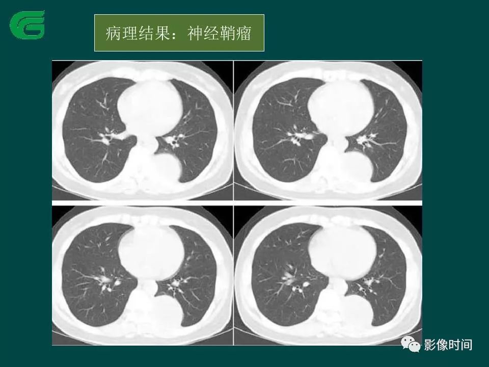 【PPT】胸膜孤立性纤维瘤的CT诊断与鉴别诊断