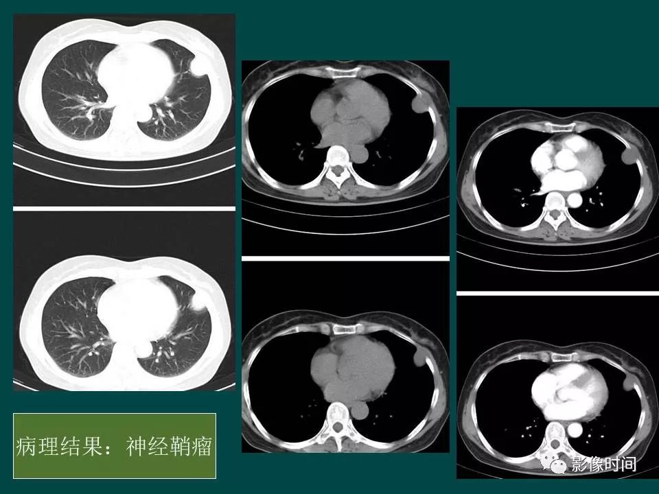 【PPT】胸膜孤立性纤维瘤的CT诊断与鉴别诊断