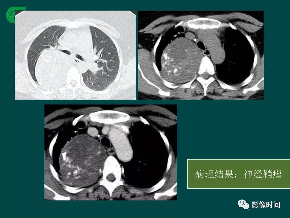 【PPT】胸膜孤立性纤维瘤的CT诊断与鉴别诊断