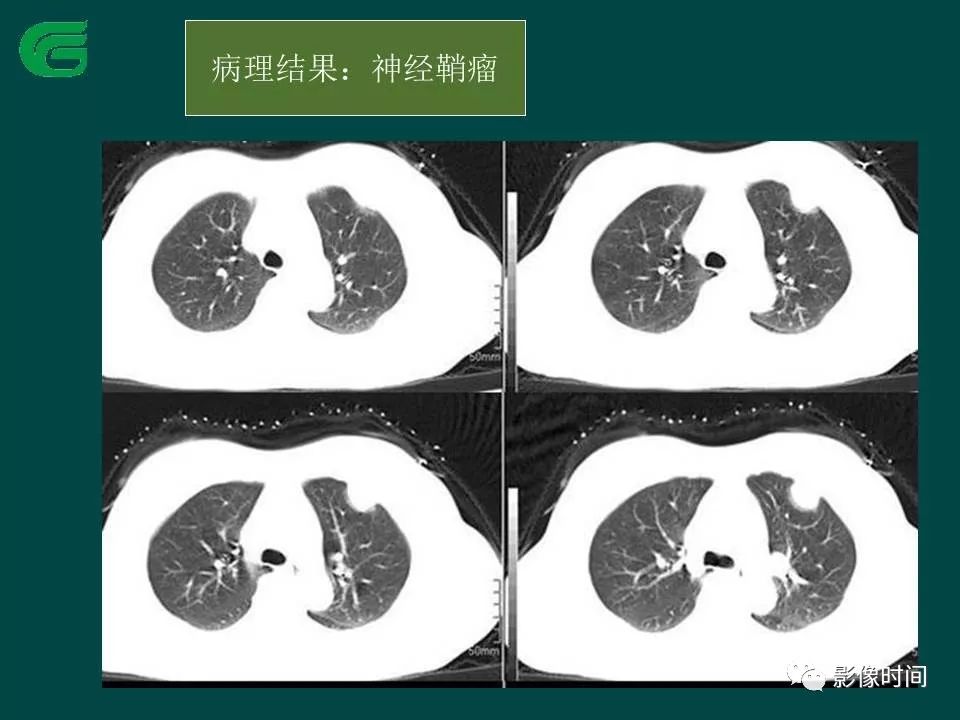 【PPT】胸膜孤立性纤维瘤的CT诊断与鉴别诊断