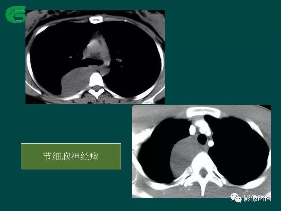【PPT】胸膜孤立性纤维瘤的CT诊断与鉴别诊断