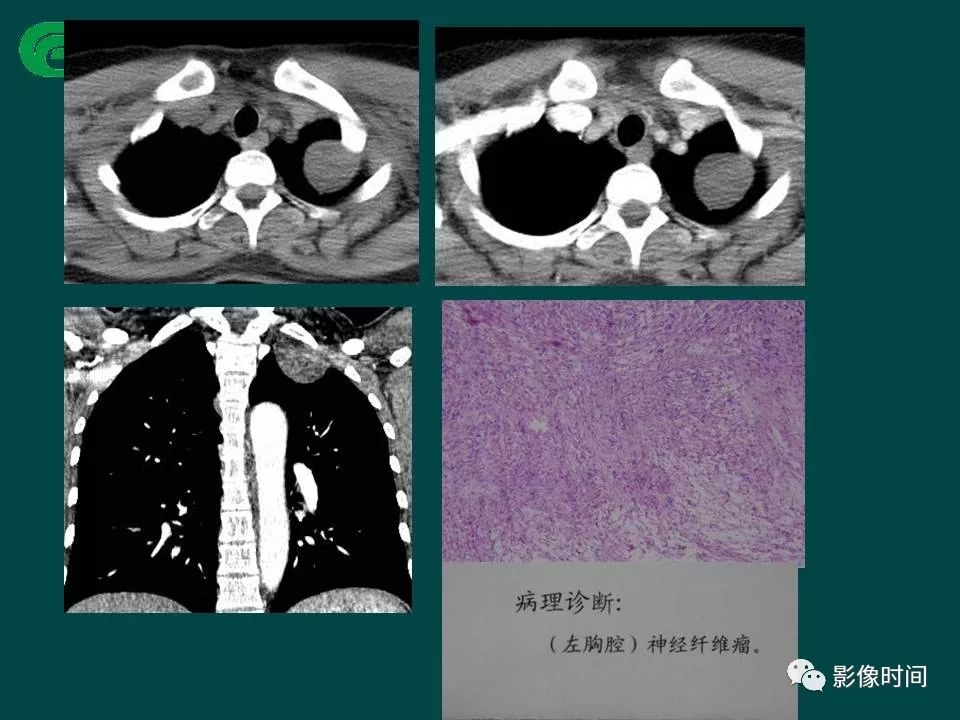 【PPT】胸膜孤立性纤维瘤的CT诊断与鉴别诊断