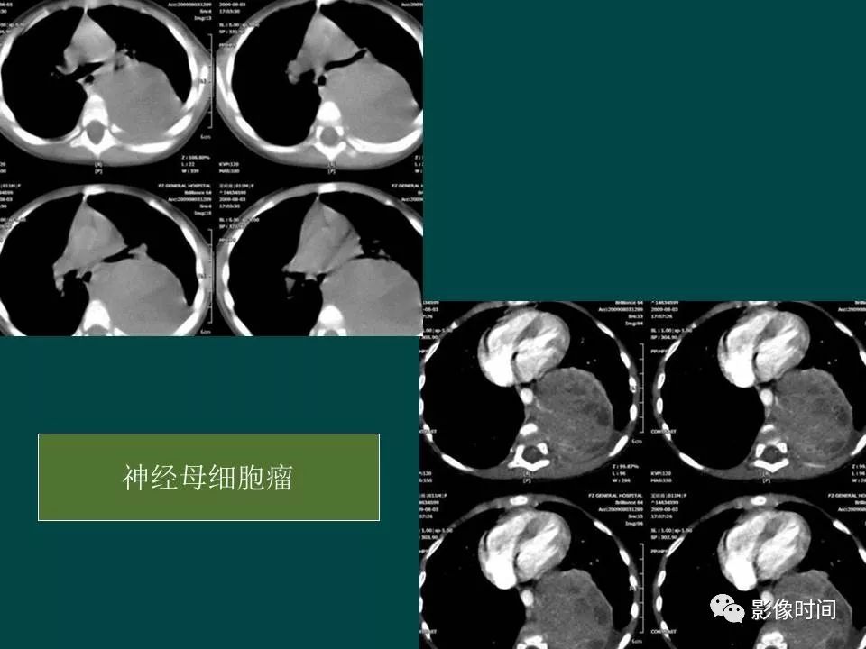 【PPT】胸膜孤立性纤维瘤的CT诊断与鉴别诊断