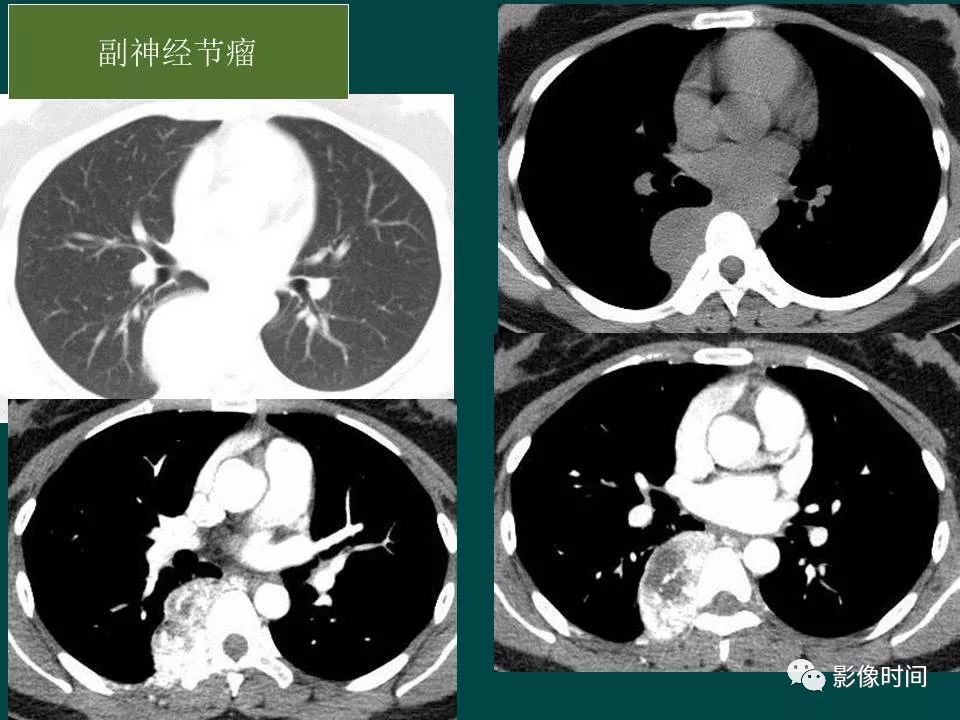 【PPT】胸膜孤立性纤维瘤的CT诊断与鉴别诊断