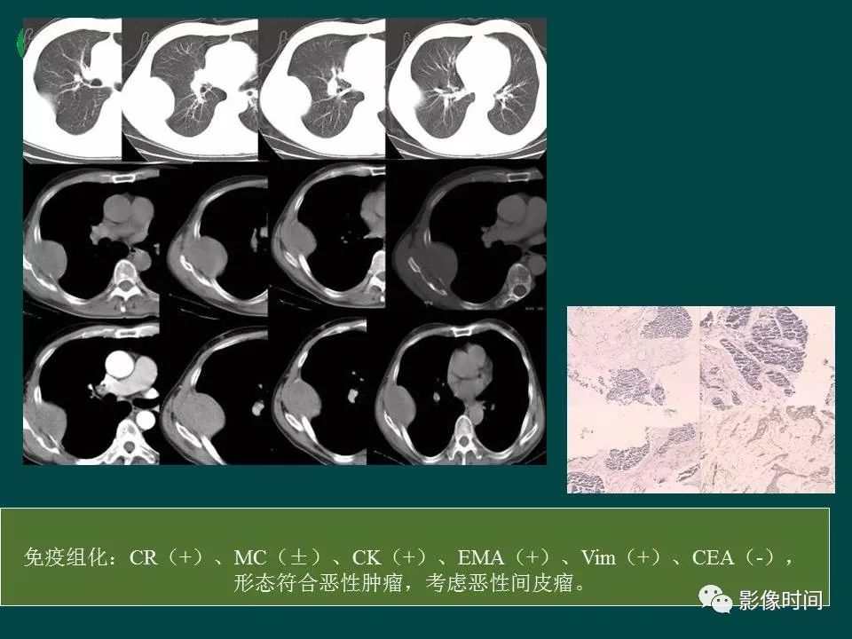 【PPT】胸膜孤立性纤维瘤的CT诊断与鉴别诊断