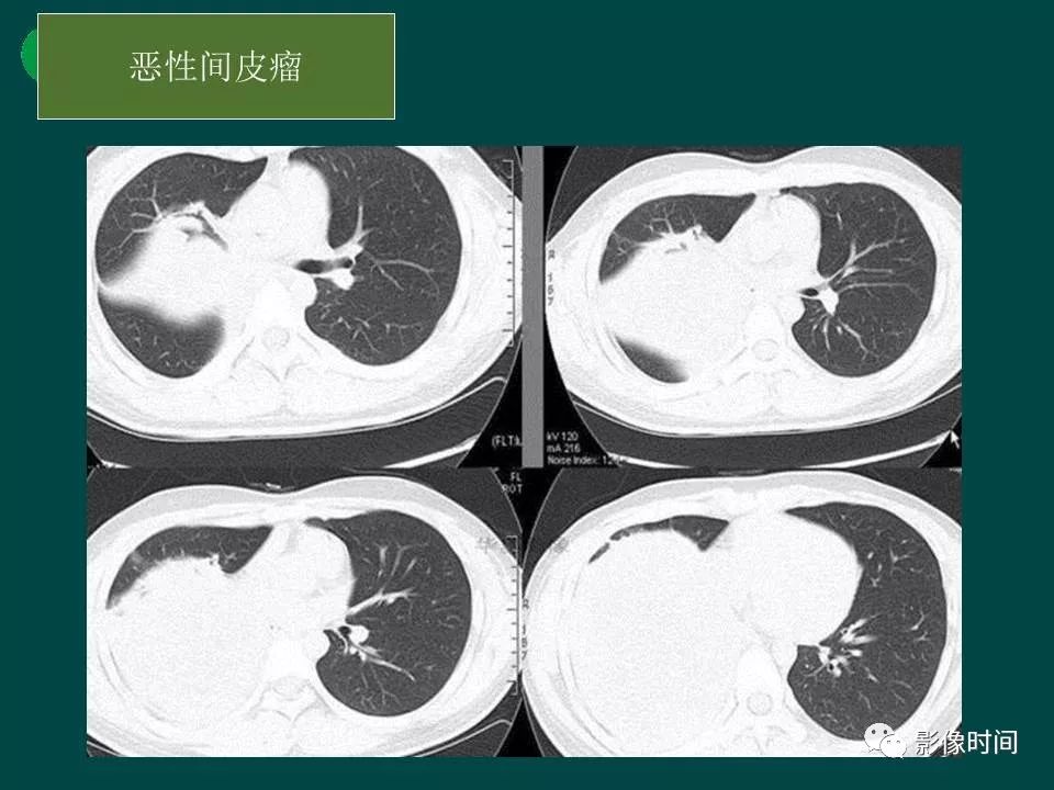 【PPT】胸膜孤立性纤维瘤的CT诊断与鉴别诊断