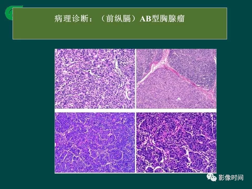 【PPT】胸膜孤立性纤维瘤的CT诊断与鉴别诊断