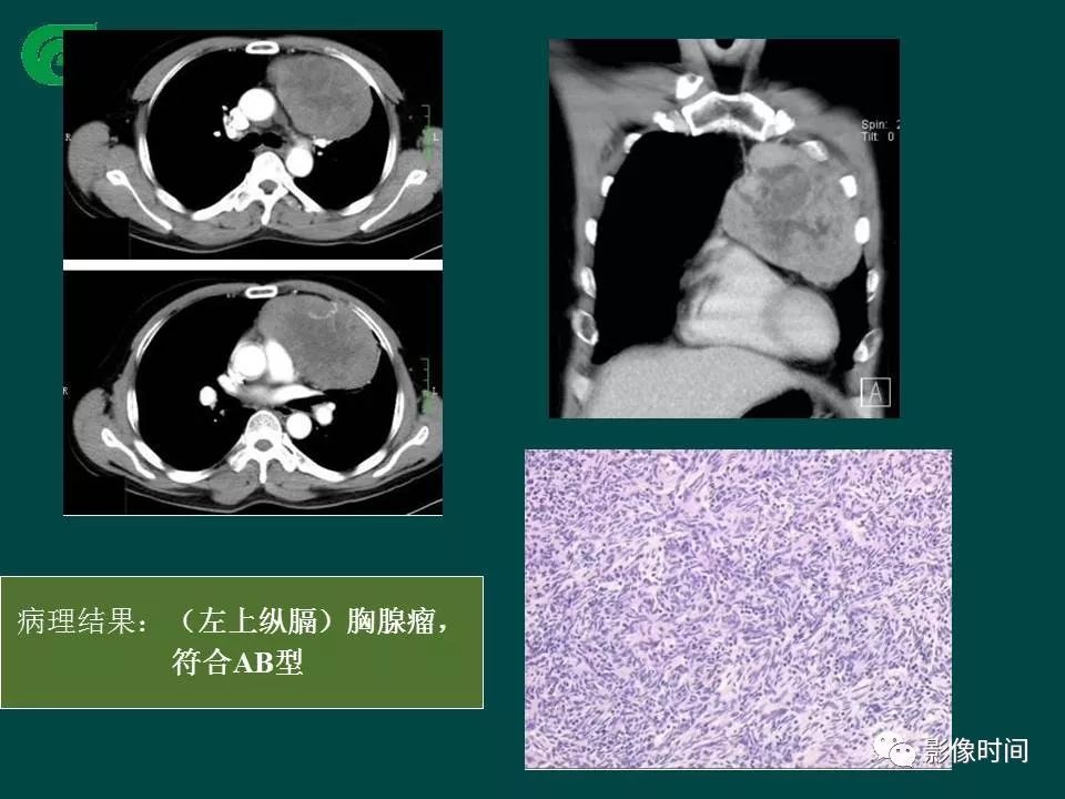 【PPT】胸膜孤立性纤维瘤的CT诊断与鉴别诊断