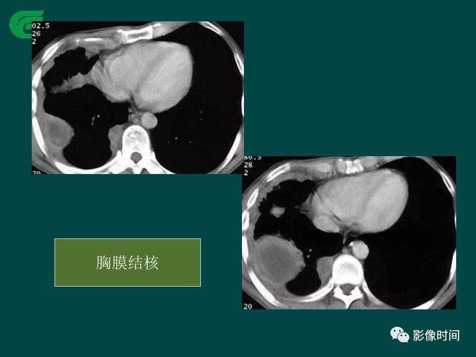【PPT】胸膜孤立性纤维瘤的CT诊断与鉴别诊断