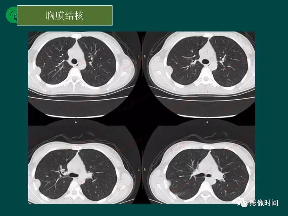 【PPT】胸膜孤立性纤维瘤的CT诊断与鉴别诊断
