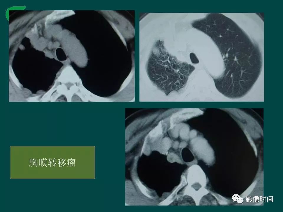 【PPT】胸膜孤立性纤维瘤的CT诊断与鉴别诊断