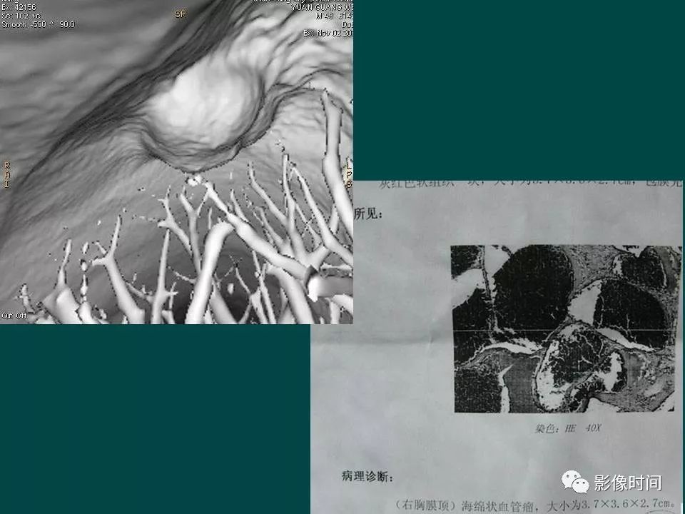 【PPT】胸膜孤立性纤维瘤的CT诊断与鉴别诊断