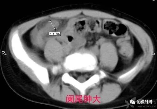 急性阑尾炎CT诊断 急性阑尾炎CT诊断
