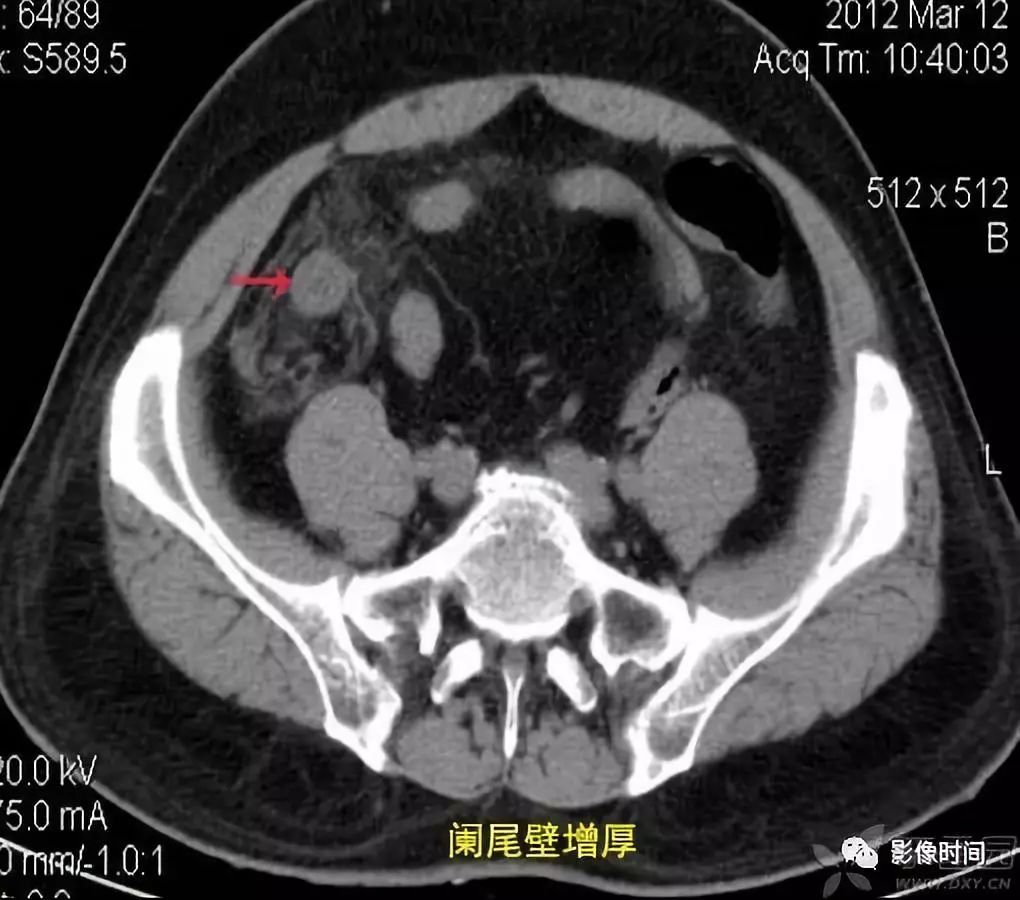 急性阑尾炎CT诊断 急性阑尾炎CT诊断