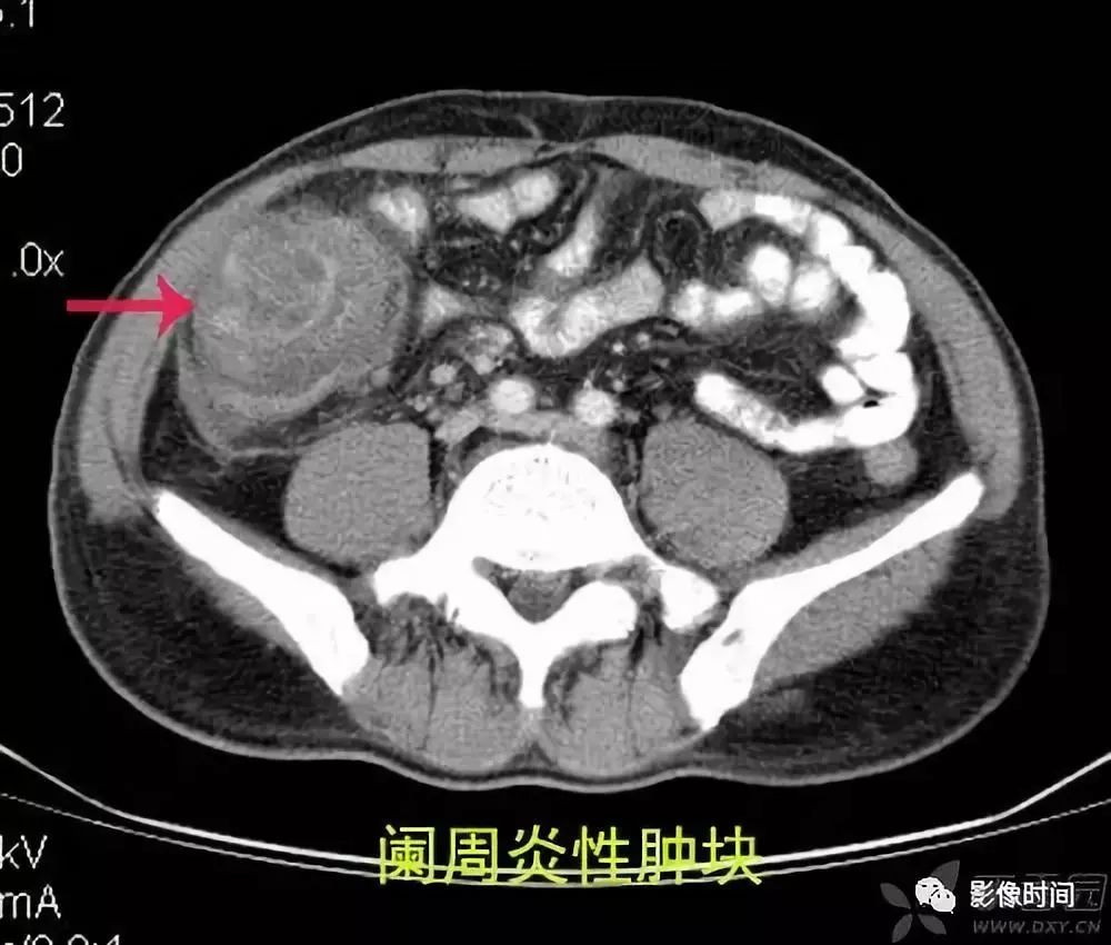 急性阑尾炎CT诊断 急性阑尾炎CT诊断
