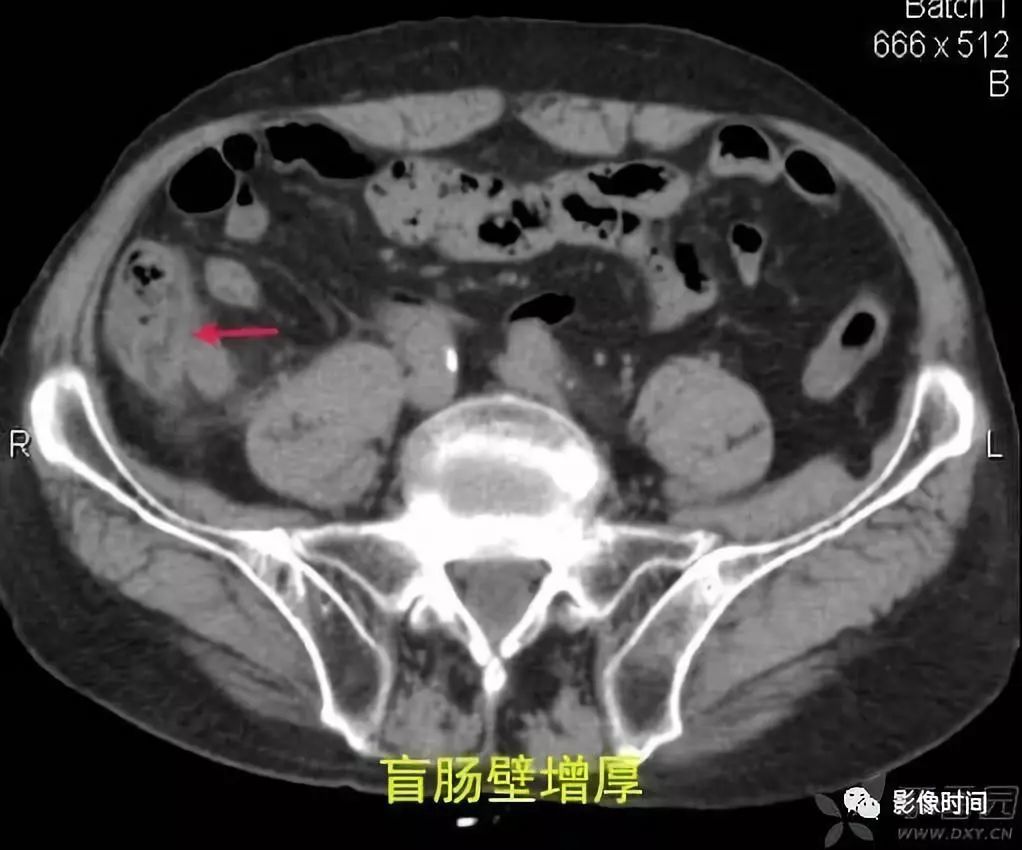 急性阑尾炎CT诊断 急性阑尾炎CT诊断