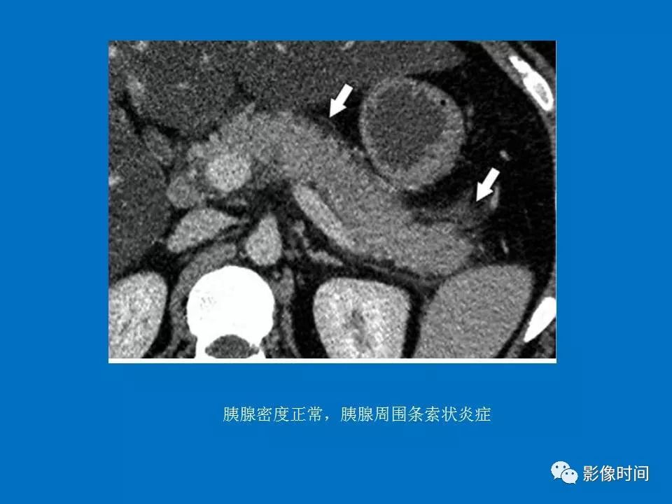 【PPT】急性胰腺炎相关知识更新