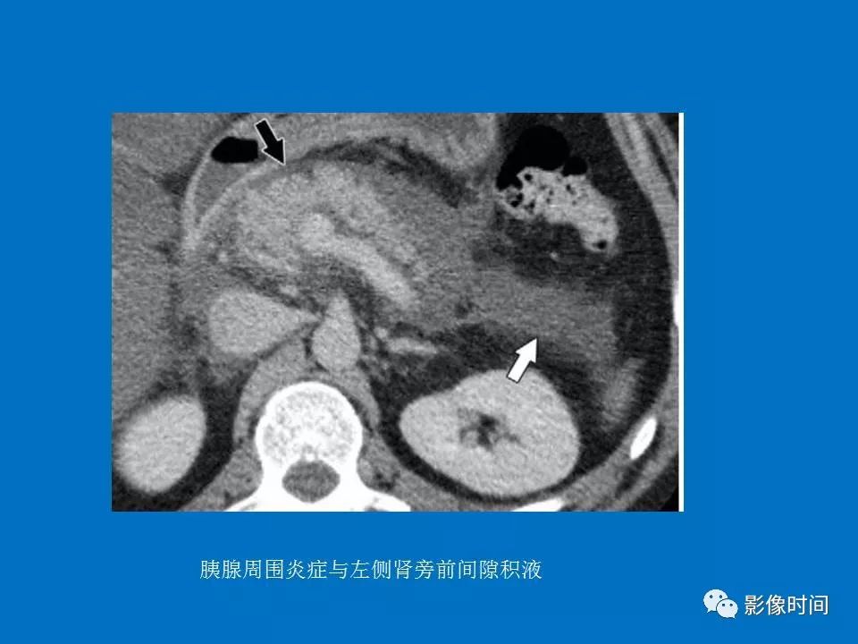 【PPT】急性胰腺炎相关知识更新