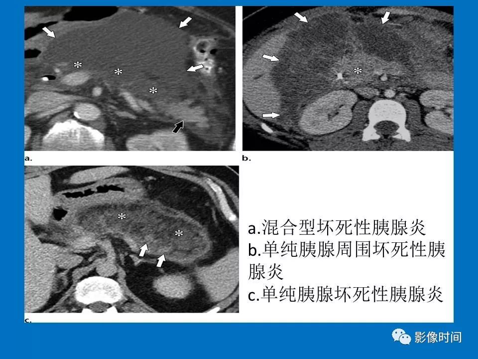 【PPT】急性胰腺炎相关知识更新