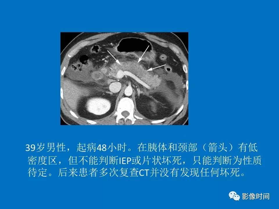 【PPT】急性胰腺炎相关知识更新