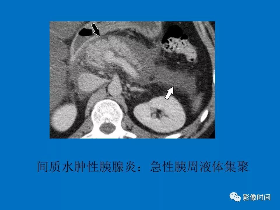【PPT】急性胰腺炎相关知识更新