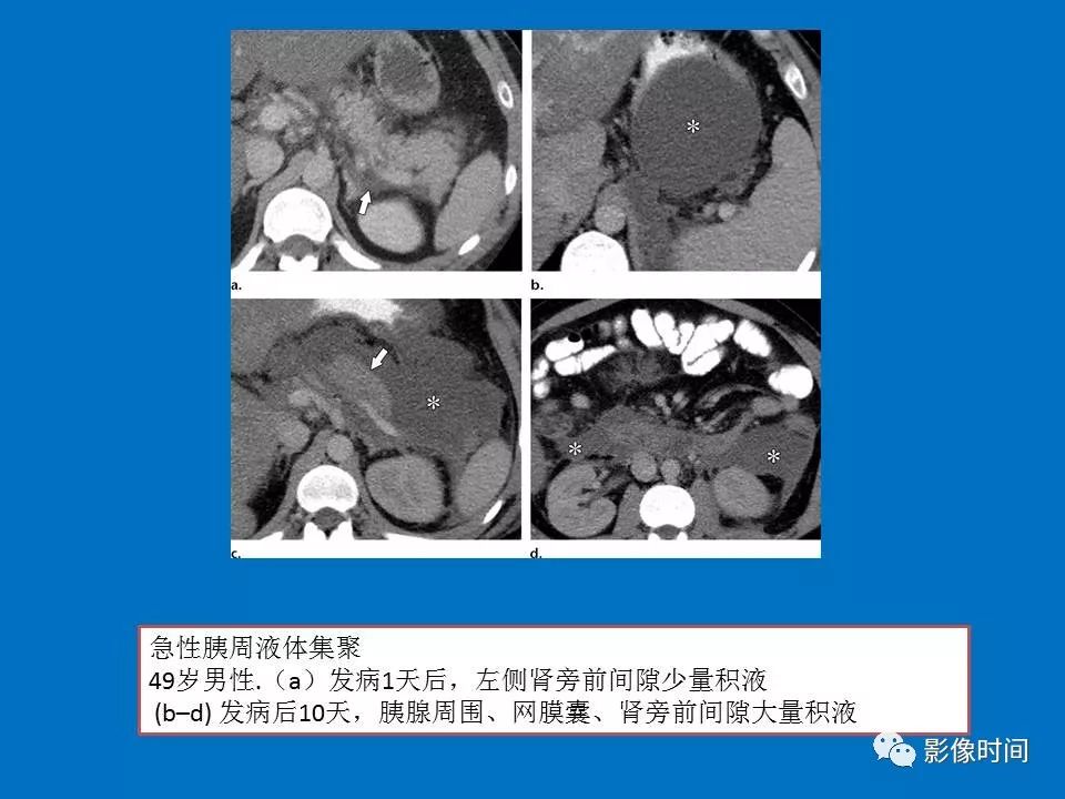【PPT】急性胰腺炎相关知识更新