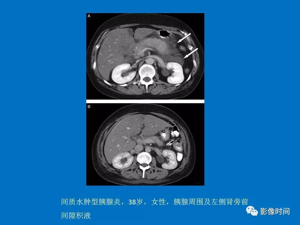 【PPT】急性胰腺炎相关知识更新