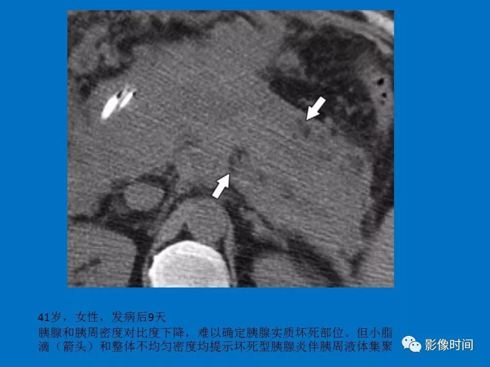 【PPT】急性胰腺炎相关知识更新