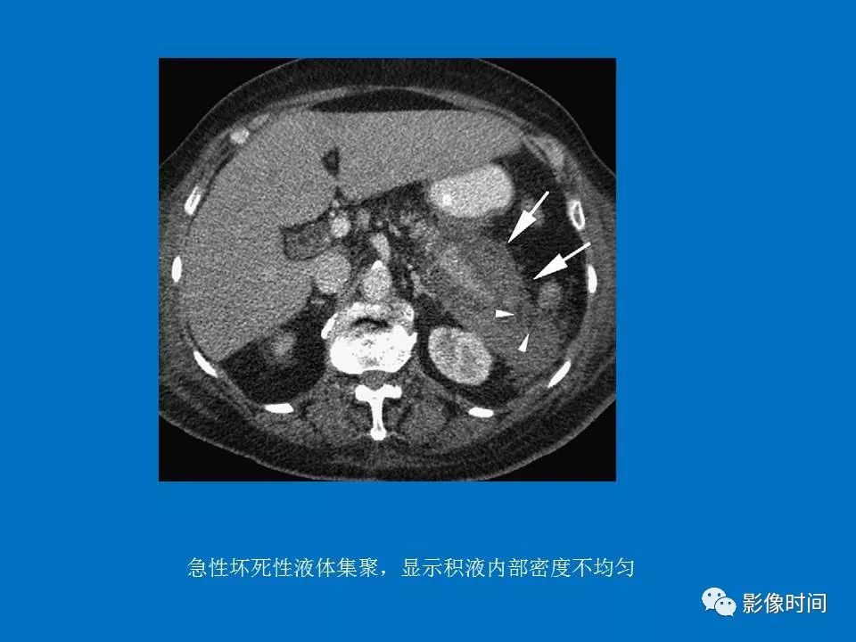 【PPT】急性胰腺炎相关知识更新
